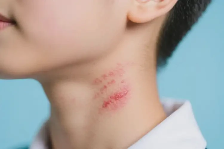 中学生脖子容易长湿疹能靠自己自愈吗(图4)