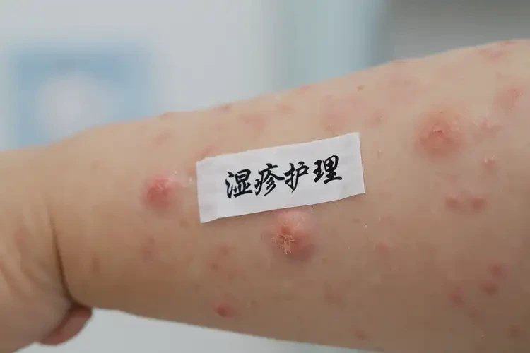 儿童屁股上起湿疹可不可以根治(图4)