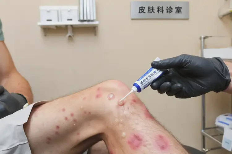 男人大腿上起湿疹不管它会自己自愈吗(图3)