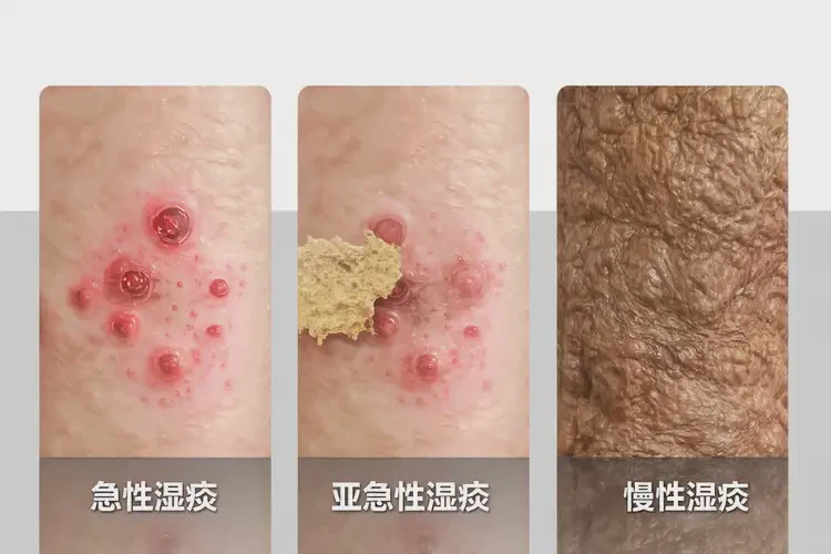 女人四肢出现湿疹不管它会自己自愈吗(图3)