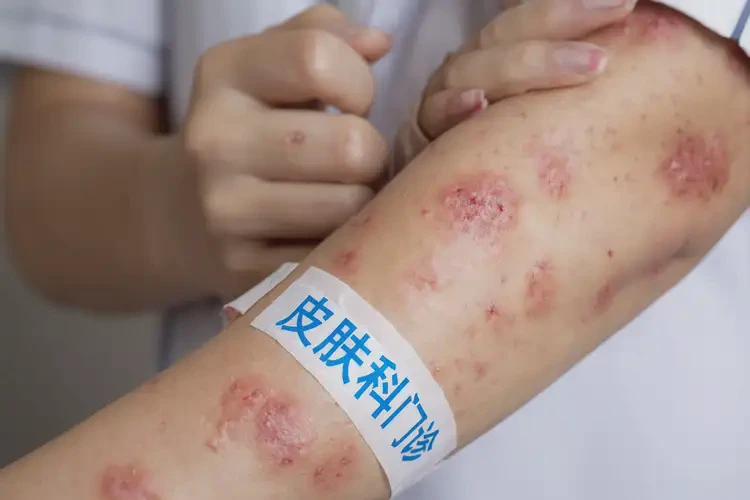青少年手臂上长湿疹不管它会自己好吗(图4)
