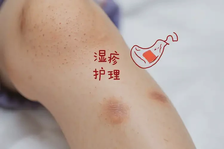 儿童小腿出现湿疹可不可以根治(图4)