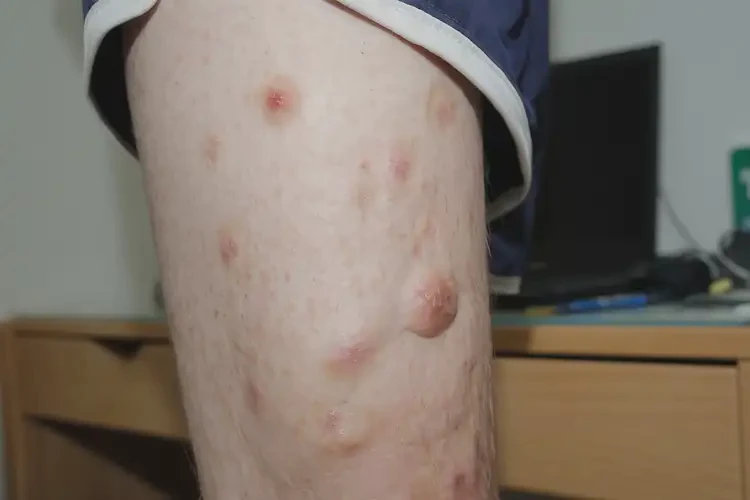 大学生大腿上有湿疹能彻底自愈吗(图2)