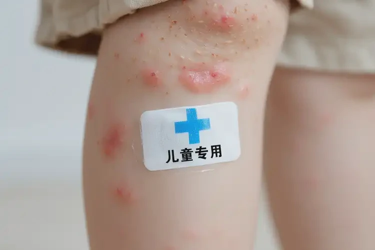 孩子大腿上容易起湿疹可不可以根治(图4)