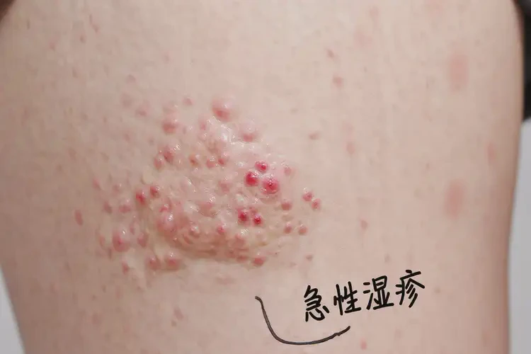 大学生大腿上有湿疹能彻底自愈吗(图4)