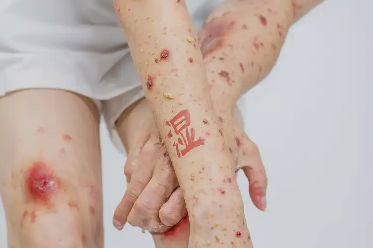 女人四肢出现湿疹不管它会自己自愈吗(图4)