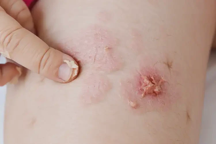 儿童大腿偶尔长湿疹可不可以根治(图4)