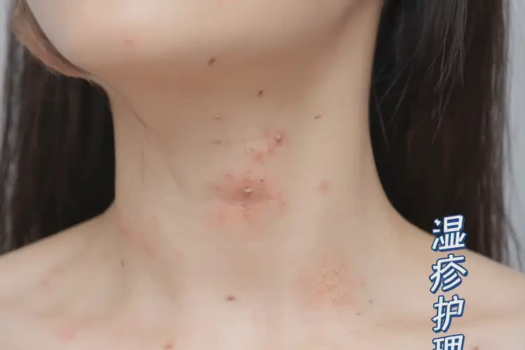 女人脖子上偶尔起湿疹可以彻底自愈吗(图4)