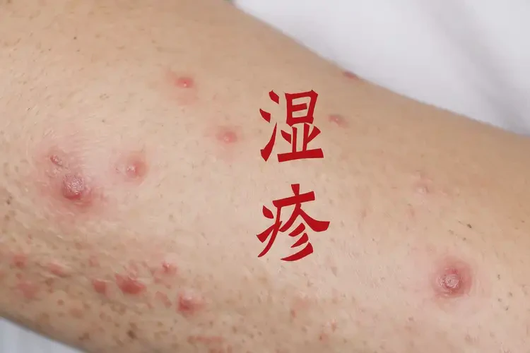 女生全身偶尔起湿疹可不可以根治(图4)