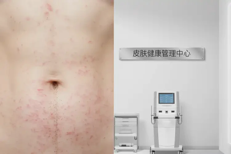 哺乳期妈妈肚子上出现湿疹能不能根治(图3)