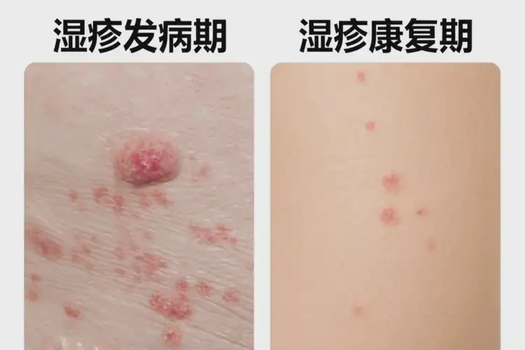 小学生肚子偶尔起湿疹能彻底自愈吗(图3)