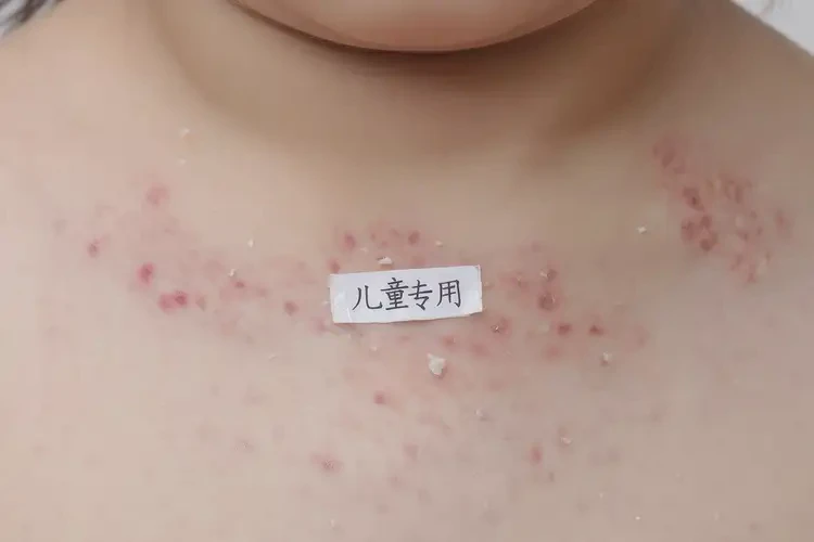 少儿脖子出现湿疹可不可以根治(图4)