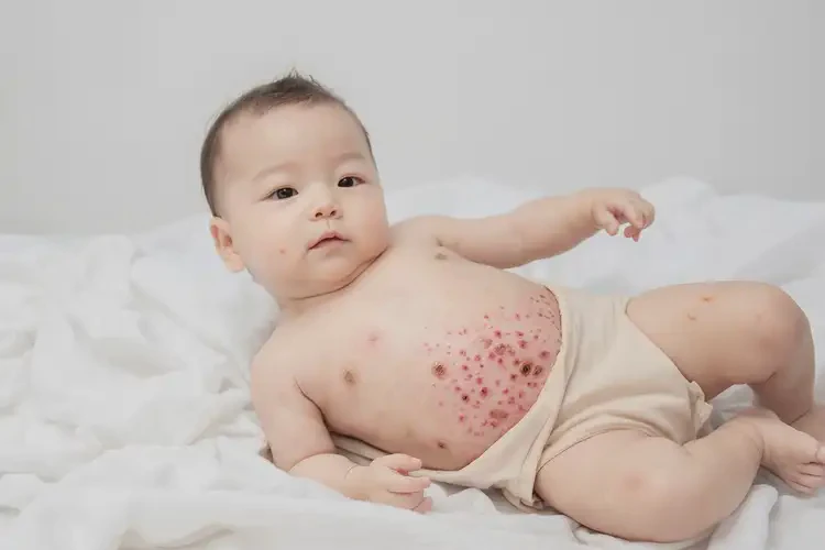 孩子肚子上偶尔长湿疹能彻底自愈吗(图3)