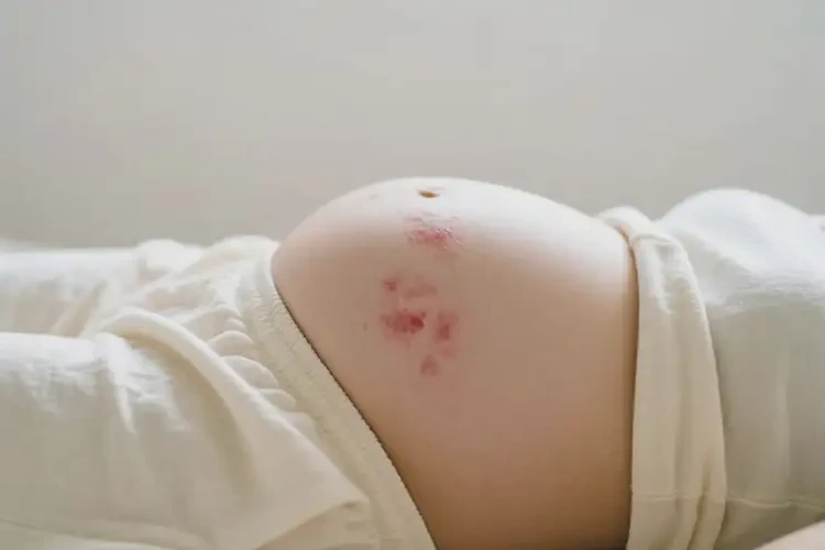 孕妇屁股上出湿疹可不可以根治(图4)