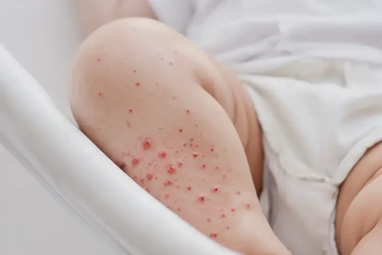 婴幼儿大腿经常起湿疹不管它会自己痊愈吗(图4)