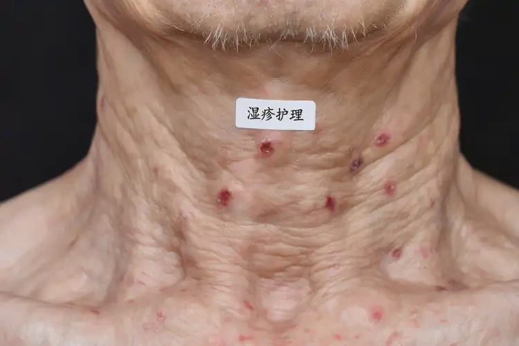 老年人脖子上偶尔起湿疹能彻底自愈吗(图4)