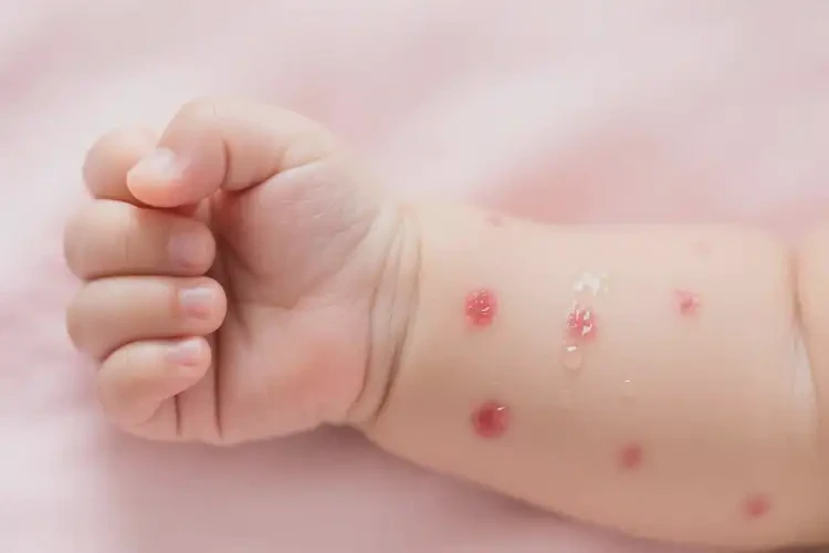 宝宝手臂上有湿疹可不可以根治(图4)