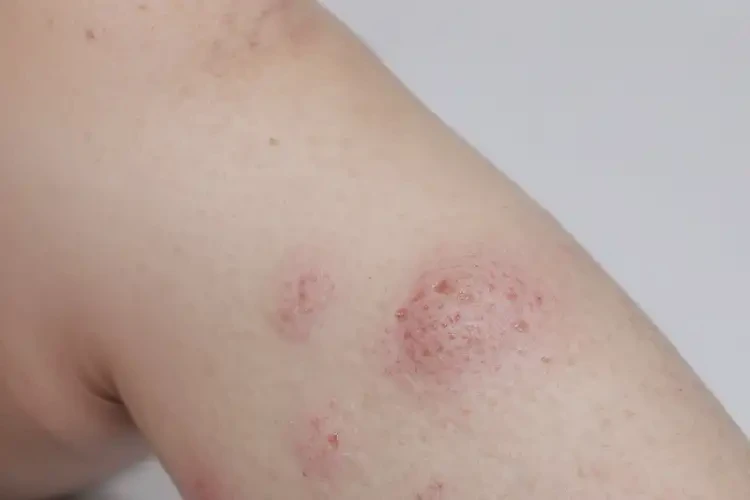 少儿小腿上有湿疹可以彻底自愈吗(图3)