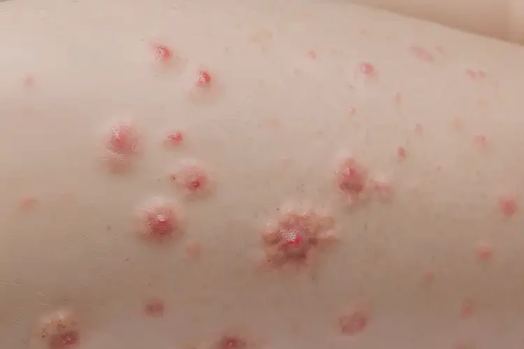 小儿大腿偶尔长湿疹可不可以根治(图3)