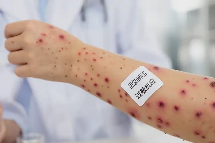儿童手臂上经常起湿疹不管它会自己痊愈吗(图4)