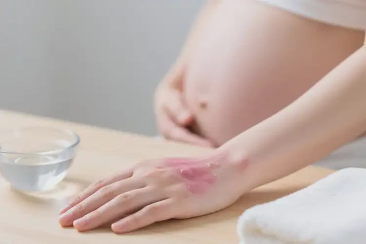 孕妇手上经常起湿疹可不可以根治(图3)