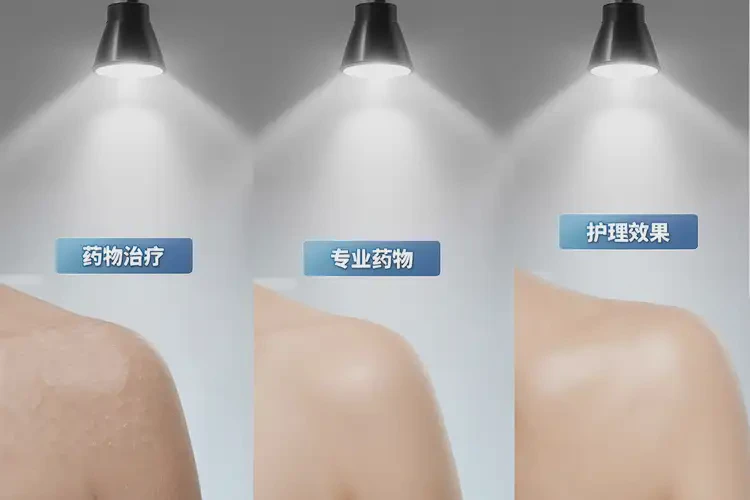 男性屁股经常长湿疹可不可以根治(图3)