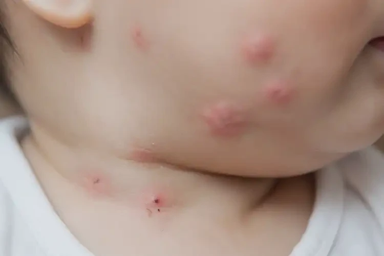 婴儿脖子上长湿疹可以治好吗(图4)