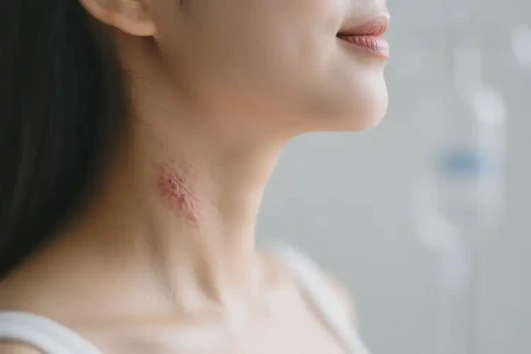 孕妇脖子上有湿疹可不可以根治(图1)