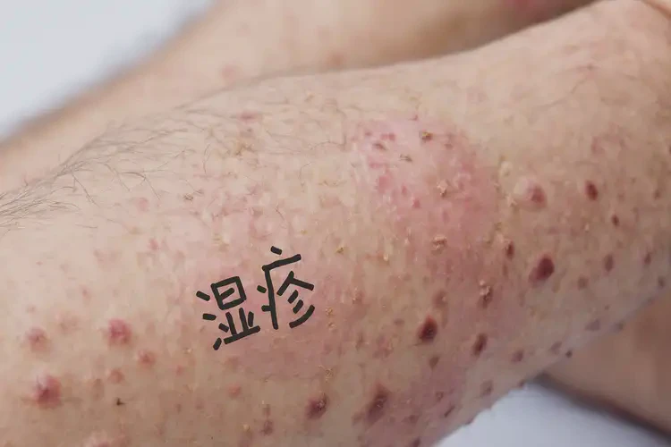男人四肢偶尔长湿疹能不能根治(图4)