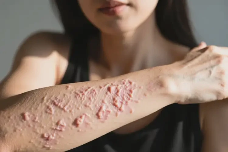 女人身上有湿疹能不能根治(图1)