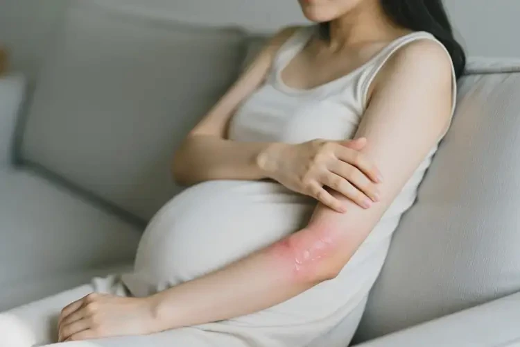 产妇手臂上出现湿疹可不可以根治(图2)