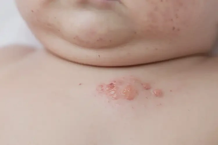 宝宝脖子偶尔长湿疹可以治好吗(图4)