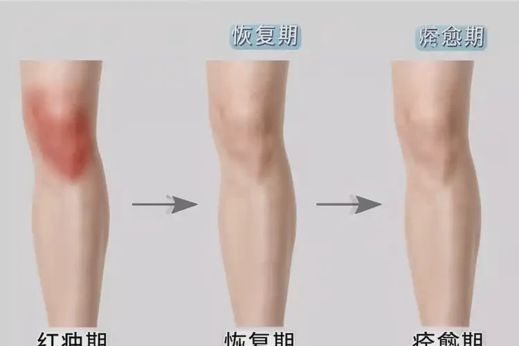 产妇小腿出现湿疹可不可以根治(图4)
