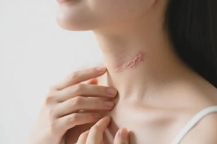 产妇脖子上出湿疹可不可以根治(图3)