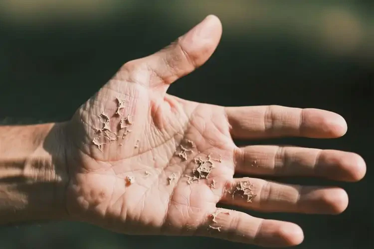 男人手上有湿疹能不能根治(图3)