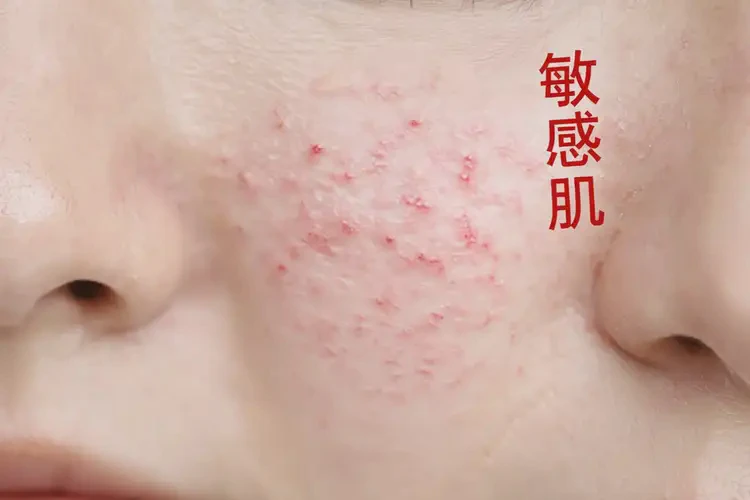 女性屁股上偶尔长湿疹可不可以根治(图4)