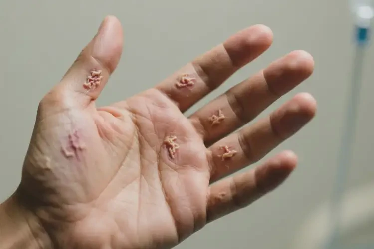 男人手上有湿疹能不能根治(图2)