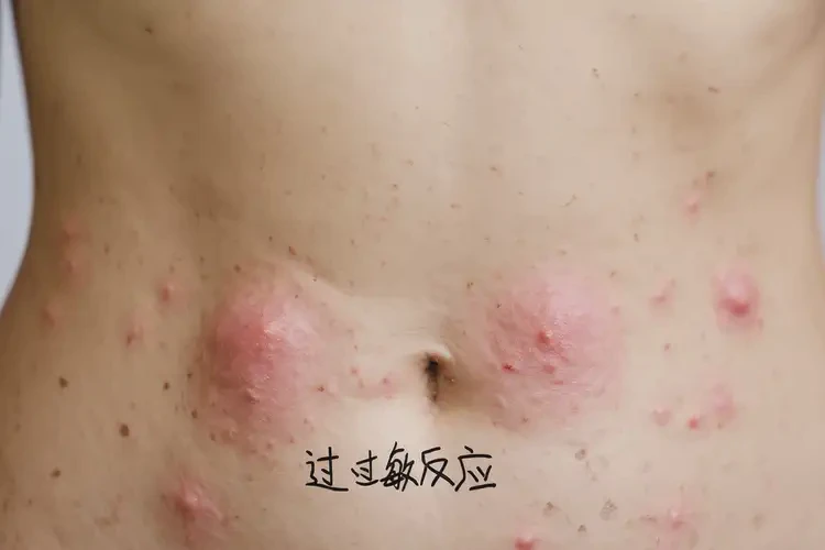 女性肚子起湿疹可不可以根治(图4)