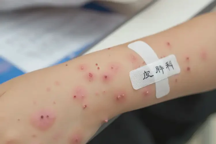 小学生手臂上偶尔起湿疹可不可以根治(图4)