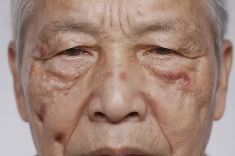 老年人脸上偶尔长湿疹可不可以根治(图4)