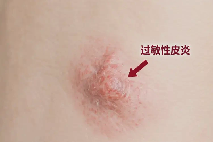 男性屁股经常长湿疹可不可以根治(图4)