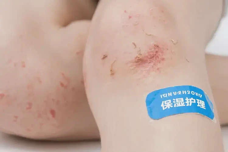 少儿小腿上有湿疹可以彻底自愈吗(图4)