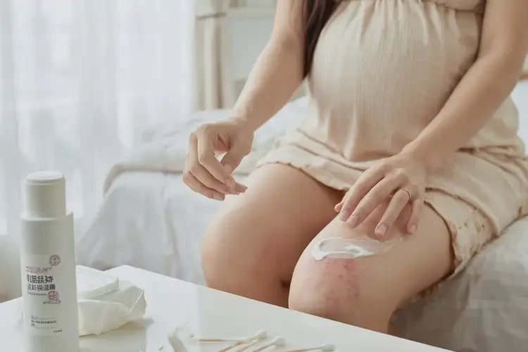孕妇大腿偶尔长湿疹可不可以根治(图4)