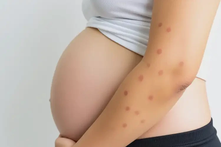 孕妇手臂有湿疹可以治好吗(图4)