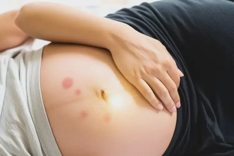 孕妇手臂上经常长湿疹可以治好吗(图1)