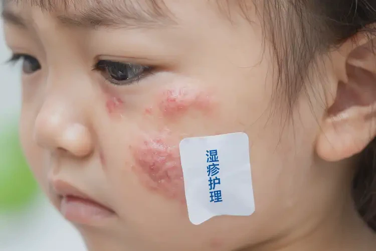 少儿脸上偶尔长湿疹可不可以彻底自愈(图4)