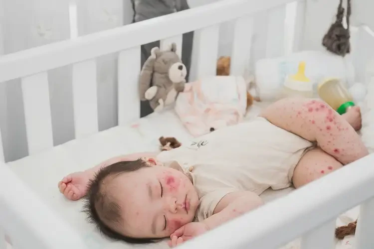 宝宝四肢容易长湿疹可以治好吗(图4)