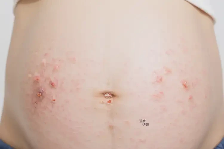 孕妇肚子经常长湿疹可以治好吗(图4)