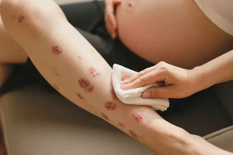 产妇小腿有湿疹可以治好吗(图2)