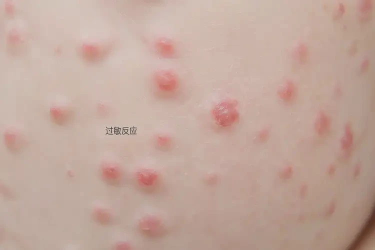 宝宝屁股有湿疹可以治好吗(图4)